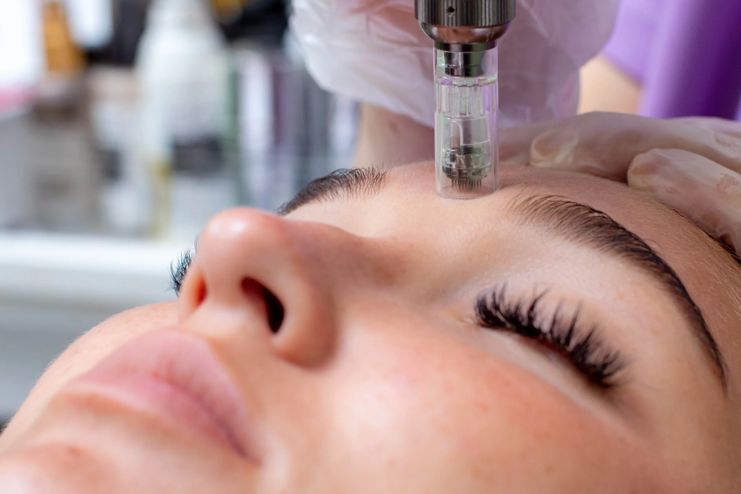 Benefits-of-Microneedling-Treatment-in-New-Rochelle-NY