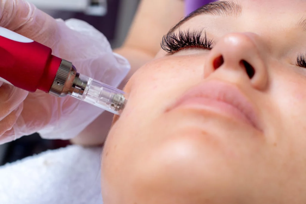 Microneedling-Treatment-in-New-Rochelle-NY