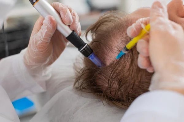 Exosome Hair Restoration